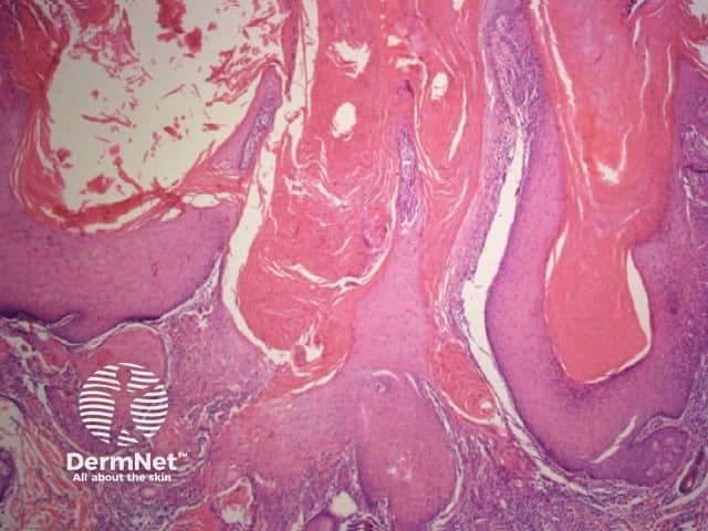 Histology image of human skin stained with Hematoxylin and Eosin (H&E) captured under light microscopy. The specimen presents a vertical cross‑section through cutaneous tissue, highlighting the epidermis overlying the dermis and extending into subcutaneous elements. The epidermal layers appear as a layered, basophilic stratum basale and strata spinosum and granulosum transitioning to a more eosinophilic stratum corneum; the dermoepidermal junction is visible as a wavy interface. The superficial dermis shows dense collagen fibers with a network of blood vessels and occasionally hair follicle–associated structures. Overall architecture resembles normal skin histology without evident dysplasia, neoplastic proliferation, or pronounced inflammatory infiltrate. The staining accentuates nuclei in blue (hematoxylin) and cytoplasmic and extracellular components in pink (eosin). This image is valuable as a reference for dermatopathology education, enabling learners to identify epidermal stratification, dermal connective tissue, adnexal structures, and the typical architecture of healthy skin. Clinically, it supports differential diagnosis consideration in cases of dermatitis, epidermal disorders, and cutaneous tumors by providing a baseline for comparison. It is suitable for medical students, residents, and researchers studying histology, dermatology, and pathology. This image also facilitates recognition of anatomical landmarks such as the epidermal-dermal junction and dermal papillae, supporting examination preparation and image-based teaching for residents and students.