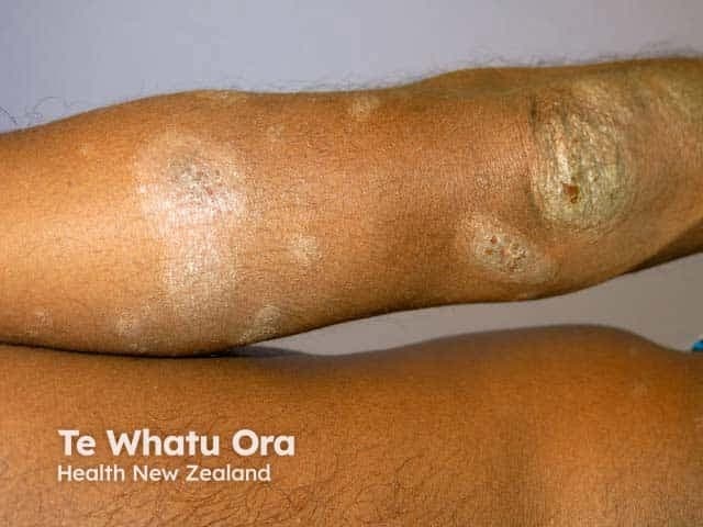 Clinical photography of skin, frontal anterolateral view of the forearm showing discoid eczema (nummular dermatitis) on darker skin. The plaques are coin-shaped, 1–3 cm in diameter, with well-demarcated, slightly scaly borders and a dry, dull sheen. Central areas show relative pallor or lighter pigment, while the outer margins exhibit erythema and hyperpigmentation consistent with postinflammatory changes common in skin of color. Surface scales are adherent, with fissuring at the edges in some plaques; minor excoriations reflect pruritus. The surrounding skin appears dry with reduced textural smoothness, characteristic of xerosis. No overt vesicles or purulent discharge are visible. The distribution is focal to the extensor aspect of the forearm, contrasting with flexural eczema patterns, and may be bilateral but is photographed unilaterally here. The appearance aligns with discoid eczema or chronic nummular dermatitis, often seen in adults with dry or compromised barrier function and irritant exposure. Secondary infection is not evident clinically. Clinically, these findings warrant management focusing on potent topical corticosteroids or calcineurin inhibitors as appropriate, stringent emollients, avoidance of irritants, and follow-up to monitor response and possible recurrence. The image provides a clear visual reference for recognition of color-variant plaque morphology and the chronicity of lesions in dermatologic practice, education, and dermatoepidemiology research.