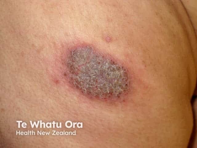 Clinical photograph of a single discoid eczema (nummular dermatitis) plaque on skin of color. Modality: Dermatology photography; technique: close-up, macroscopic view, non-dermoscopic; the lesion is coin-shaped (round to oval), well-demarcated, approximately 1.5–2 cm in diameter. Central area shows diffuse scaling with a crusted surface of grayish-brown hue, surrounded by an erythematous, slightly edematous border. The surrounding skin demonstrates post-inflammatory hyperpigmentation typical of darker phototypes. Textural change includes thickened, xerotic skin with mild fissuring at the periphery. No adjacent vesicles or pustules are evident. Lighting shows warm undertones; surface reveals adherent scale and crust, reflecting chronic inflammation. The differential diagnosis includes tinea corporis, plaque psoriasis, contact dermatitis, and chronic eczema variants; clinical correlation with pruritus, chronicity, and relapsing-remitting pattern favors discoid eczema. In skin of color, hyperpigmentation can persist after inflammation, which may complicate assessment of lesion boundaries. This image is valuable for education on morphology of coin-shaped eczematous plaques and for distinguishing discoid eczema from fungal infections in pigment-rich skin. Potential clinical use cases include dermatology training, telemedicine skin lesion assessment, comparative studies of pigmentary responses, and monitoring response to topical corticosteroids and emollients. This single-field photograph supports recognition of characteristic features: well-marginated plaque, central scaling/crusting, erythematous halo, and pigmentary change.
