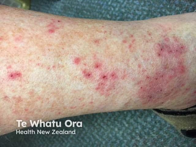 This image is a high-resolution clinical photograph of the left ankle region showing discoid eczema (nummular dermatitis). The skin exhibits multiple coin-shaped erythematous plaques, approximately 0.5–2 cm in diameter, with dry scaling, peripheral crusting, and mild surface excoriation from pruritus. Lesions are well-demarcated and arranged singly and in small clusters along the lateral malleolar area and distal lower leg. Perilesional erythema and xerosis are evident; surrounding skin appears dry without overt infection. The pattern is localized to the ankle region, a common site for discoid eczema, though plaques may appear on dorsum of hands or extensor surfaces in other contexts. Differential considerations include tinea corporis, contact dermatitis, psoriasis, and seborrheic dermatitis. Clinically, discoid eczema is associated with atopy and chronic itch, and management focuses on skin hydration, regular emollients, and anti-inflammatory therapy (topical corticosteroids and calcineurin inhibitors) with avoidance of irritants. This image serves as an educational reference for annular plaque dermatoses, differential diagnosis, and treatment response assessment in chronic eczematous skin disease.