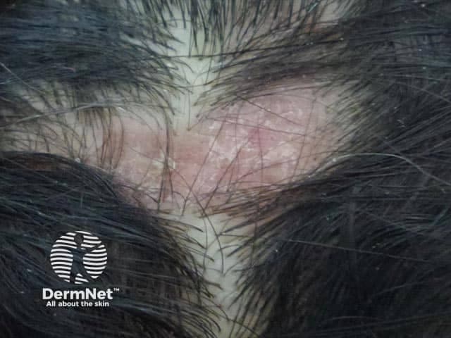This is a dermatology clinical photograph of a scalp lesion in a patient with discoid lupus erythematosus (DLE). Modality and technique: color digital clinical photography, high-resolution close-up scalp image, frontal orientation. Anatomic localization: scalp skin over the vertex with involvement of the parietal regions. Visual characteristics include red-to-violaceous erythematous plaques with thick adherent scale, focal crusting, and patchy, scarring alopecia with hair shaft destruction; perifollicular hyperkeratosis and follicular plugging may be evident. The lesion shows surface inflammation with atrophic scarring on the affected areas, consistent with active discoid lupus and potential cicatricial alopecia. If biopsy were performed, histology would typically reveal interface dermatitis with a lymphocytic infiltrate and dermal mucin; clinical context remains essential. This image is diagnostic for a scarring alopecic disorder and is clinically significant for differentiating DLE from psoriasis, seborrheic dermatitis, tinea capitis, and lichen planopilaris. Diagnostic significance includes recognition of scarring alopecia risk, need for serologic evaluation, and consideration of antimalarials and topical therapies. Clinical correlation includes sun protection and monitoring for systemic lupus erythematosus. Educational use encompasses dermatology training, case-based learning, and AI-assisted image analysis of scalp inflammatory dermatoses. The image also serves as a reference for documenting progression and treatment response in both pediatric and adult patients.
