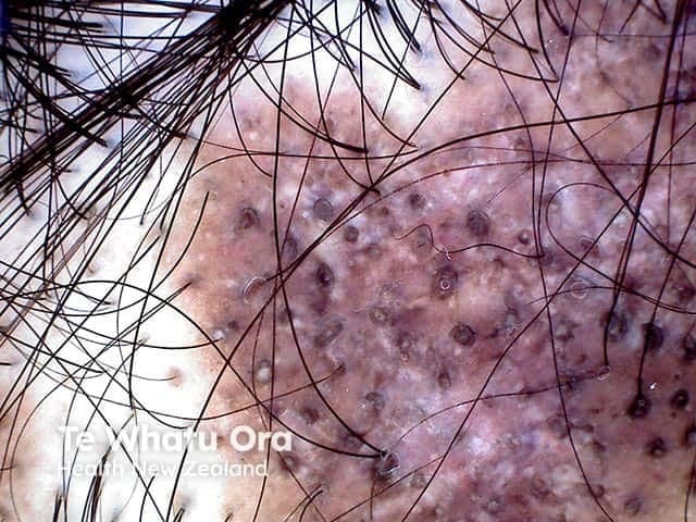 This in vivo scalp dermoscopy/trichoscopy image shows a localized discoid lupus erythematosus lesion presenting with scarring alopecia. The study field is the scalp skin, captured in a close‑up en‑face view at moderate magnification. The scalp surface demonstrates patchy erythema and diffuse hypopigmentation with conspicuous follicular plugging (keratotic follicular openings) and reduced hair follicle ostia consistent with cicatricial alopecia. The numerous dark dot-like structures correspond to follicular openings and keratin plugs, while atrophic scarring regions reveal diminished follicular density and linear scarring tracts. Perifollicular scaling and milky red zones reflect underlying inflammation and vascular changes; crusts or hyperkeratotic scales may be present. These trichoscopic findings, together with clinical history of discoid lupus erythematosus, support a diagnosis of DLE‑related cicatricial alopecia. The imaging is particularly useful for distinguishing scarring alopecias from non-scarring types and for monitoring disease activity or response to antimalarial therapy. Clinically, this pattern raises considerations of photodistributed disease, potential progression to extensive scalp involvement, and need for biopsy correlation and serologic assessment. In educational contexts, this image serves as a reference for dermatology, trichology, and rheumatology collaborations, illustrating hallmark DLE features and differential diagnoses such as lichen planopilaris and inflammatory scarring alopecias.