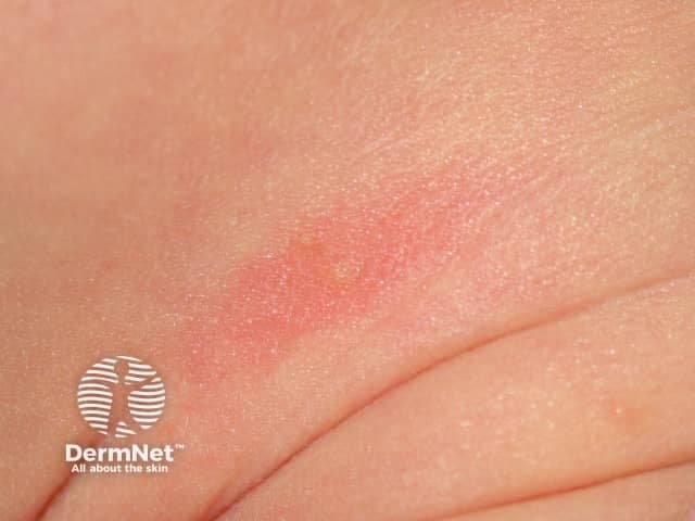 Imaging modality: Clinical photography; Technique: close-up, color standard photograph of neonatal skin under balanced lighting. Anatomical location: neonatal trunk and proximal limbs; Cutaneous findings: scattered erythematous macules and papules with occasional small pustules on an erythematous base, most prominent on the torso and arms. Pathology and description: erythema toxicum neonatorum; eosinophilic pustules within inflamed epidermis without systemic symptoms; benign inflammatory eruption that often appears within the first 24-48 hours of life and resolves spontaneously within 1-2 weeks. Diagnostic significance: common, self-limited neonatal rash requiring only observation; differentiation from infection (neonatal herpes simplex, candidiasis) or other pustular conditions is essential. Clinical correlation: no fever or irritability typically; may be associated with transient eosinophilia; management is reassurance. Context: used in dermatology education and neonatal care to illustrate benign neonatal dermatoses; useful for clinicians assessing newborn rashes and teaching about differential diagnosis, natural history, and parental counseling. Imaging features: non‑bullous pustules on erythematous base, variable distribution across trunk and proximal extremities; resolution aligns with maturation of skin. This image demonstrates classic erythema toxicum features without crusting or vesicular breakdown. Clinical notes emphasize observation, supportive care, and parental reassurance; no antibiotics are routinely required unless signs of secondary infection or systemic illness emerge. Uncommonly.