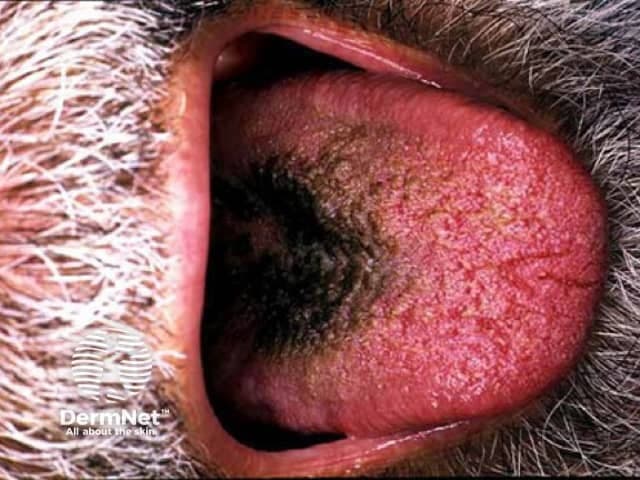 Clinical photography of the left periorbital skin demonstrating an erythematous, scaly plaque along the upper eyelid margin. The lesion is well demarcated, with red to pink erythema and fine superficial desquamation; mild crusting is present at the center and along the lid edge. Surrounding skin shows mild irritation without confluent swelling. The ocular surface appears not to be visibly involved; no purulent discharge is evident. The pattern is unilateral, localized to the periorbital region, compatible with common inflammatory dermatoses affecting the eyelid, rather than a primary ocular pathology. Differential diagnoses include seborrheic dermatitis of the eyelids, atopic or contact dermatitis, blepharitis with dermatitis, and less likely psoriasis or fungal infection. The image emphasizes surface features such as hyperemia, scaling, fissuring, and crusts, with the lid margin appearing slightly thickened. This clinical photo supports assessment of periorbital dermatitis, eyelid dermatitis, and blepharitis variants, and can guide topical therapy decisions. While histology is not available from a photograph, correlating with history and, if needed, skin scraping or biopsy could clarify diagnosis. Potential clinical uses include education, documentation of eyelid dermatitis severity, and monitoring response to topical steroids, calcineurin inhibitors, or antiseborrheic shampoos. This image supports teaching, case discussions, and diagnostic reasoning sessions.