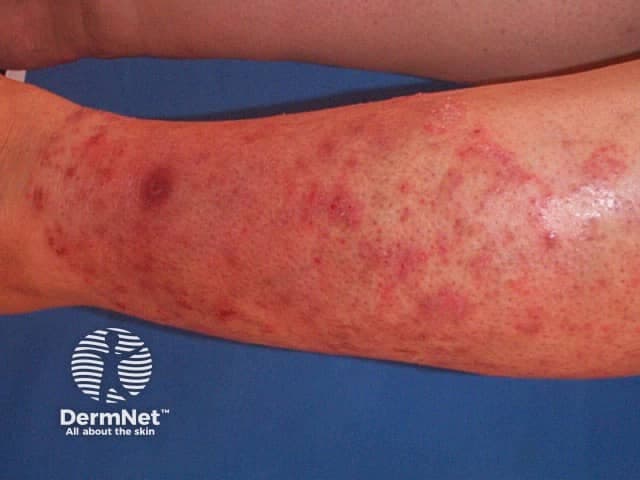 Clinical photography of a forearm displaying multiple annular, erythematous plaques with well-defined, advancing borders and central clearing, typical of tinea corporis (dermatophytosis). The lesions show fine superficial scaling and variable edema at the margins, with surrounding erythema and coalescence along the antebrachial region. This cutaneous fungal infection is usually acquired through contact with contaminated skin or fomites and commonly affects exposed extremities. The image emphasizes characteristic ring-shaped morphology (circinate lesions) with peripheral scale and a central clearing area, aiding visual recognition in dermatology and primary care settings. Diagnosis is supported by mycologic testing such as potassium hydroxide (KOH) prep revealing hyaline septate hyphae and by fungal culture identifying dermatophyte species (Trichophyton, Microsporum, Epidermophyton). Wood lamp examination may yield fluorescence for select organisms. Clinically, this finding is relevant for infectious disease, dermatology, and medical education, and it prompts antifungal therapy and hygiene measures. Differential considerations include nummular eczema, plaque psoriasis, pityriasis rosea, and less likely pityriasis versicolor. The image serves as an educational reference for recognition, differential diagnosis, and treatment planning in dermatology and general medicine. In educational contexts, this image supports case-based learning, clinical reasoning, and patient counseling about transmission, medication adherence, and skin care. Follow-up imaging may document treatment response.