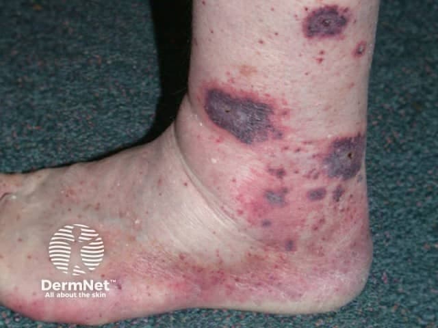 Clinical photography of the skin demonstrates multiple non-blanching, violaceous purpuric patches and plaques concentrated over the distal leg, ankle, and surrounding soft tissue. The lesions are irregular in shape, vary in size from a few millimeters to several centimeters, and appear coalescent in places with mild surrounding erythema and edema. This distribution on the lower extremity is classic for small-vessel vasculitis presenting as palpable purpura, most consistent with leukocytoclastic vasculitis, cutaneous IgA vasculitis, or a hypersensitivity process. The photograph provides a frontal view of the distal leg and ankle, capturing surface morphology including color gradient from dark purple to burgundy, subtle scaling, and surface fragility. In a clinical context, such skin findings warrant correlation with laboratory studies (CBC for thrombocytopenia, ESR/CRP for inflammation, renal function tests, urinalysis for nephritis) and serologies (ANCA, complement levels). Differential diagnoses include drug-induced vasculitis, cryoglobulinemic vasculitis, Henoch–Schönlein purpura, and other systemic vasculitides; trauma or coagulopathy can mimic purpura but typically have different distribution or blanching pattern. Management relies on clinical staging and systemic involvement; biopsy may be required for definitive histopathology. Early recognition supports prompt treatment and reduces risk of organ involvement. Clinical follow-up and biopsy may refine diagnosis and guide targeted therapy for confirmation.