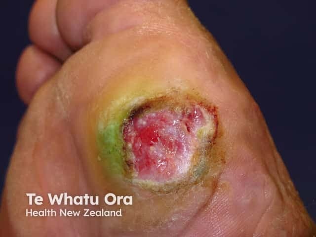 Clinical photography of a neuropathic foot ulcer. Modality: color digital photograph capturing dorsal aspect of the foot. The lesion is a round to irregular shallow ulcer located on the dorsum near the digits, displaying a moist, pink-red wound bed with areas of yellowish slough at the center and surrounding periwound erythema. The wound margins are largely defined with a surrounding greenish-yellow discoloration perhaps indicative of slough or necrotic tissue, and peripheral edema. The periwound tissue shows mild erythema and induration; the surrounding skin may be callused. The imaging reveals features typical of a neuropathic ulcer in the setting of diabetes mellitus: loss of protective sensation with impaired healing capacity; reduced perfusion may contribute to wound chronicity. The central wound bed lacks a robust epithelial rim, indicating ongoing tissue breakdown and delayed healing. Clinically, this image would be used for wound assessment, staging, and monitoring response to therapy, including debridement, offloading, advanced dressings, infection surveillance, and consideration of vascular assessment. Differential diagnoses include diabetic (neuropathic) foot ulcer, ischemic or mixed arterial insufficiency ulcers, pressure ulcers, and venous stasis ulcers, but the profile strongly supports neuropathic etiology. This image is relevant for medical education, wound care, dermatology, endocrinology, podiatry, and research on diabetic complications.