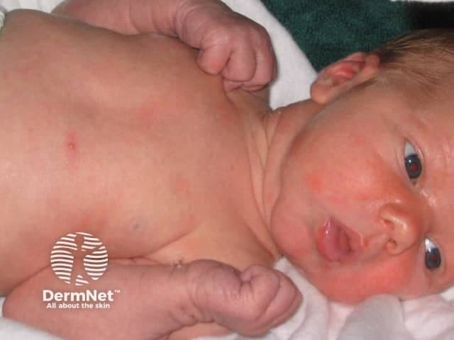 Clinical photography of a term neonate demonstrating erythematous papules and vesicles distributed primarily on the trunk and face. Imaging modality: Clinical photography; technique: high-resolution color image captured in natural or balanced lighting, frontal/anterior view with the infant supine. Anatomical localization: integumentary system; neonatal skin (epidermis and superficial dermis). Visual features include numerous small 1–3 mm erythematous papules and vesicles on an erythematous base, some showing a pale or yellowish vesicular center; lesions are non-follicular and non-desquamative, arranged in scattered coalescent patches but with overall benign appearance. There is no edema, crusting, or purpura; mucous membranes spared; no systemic signs of illness. Clinically diagnostic for erythema toxicum neonatorum (ETN), a common benign neonatal eruption typically appearing within 24–72 hours of birth and resolving spontaneously within 1–2 weeks. Haematologic or infectious etiologies are not supported by the image alone; no systemic symptoms; differential considerations include milia, miliaria rubra, transient neonatal pustular melanosis, neonatal pustular psoriasis, and less commonly neonatal herpes. Pathophysiology involves eosinophilic inflammatory response; management is reassurance and observation; no antimicrobial therapy required unless accompanied by fever or sepsis concern. The image is relevant for educational purposes in dermatology, pediatrics, and neonatology to illustrate ETN morphology, distribution, natural history, and differentiation from other neonatal pustular conditions.