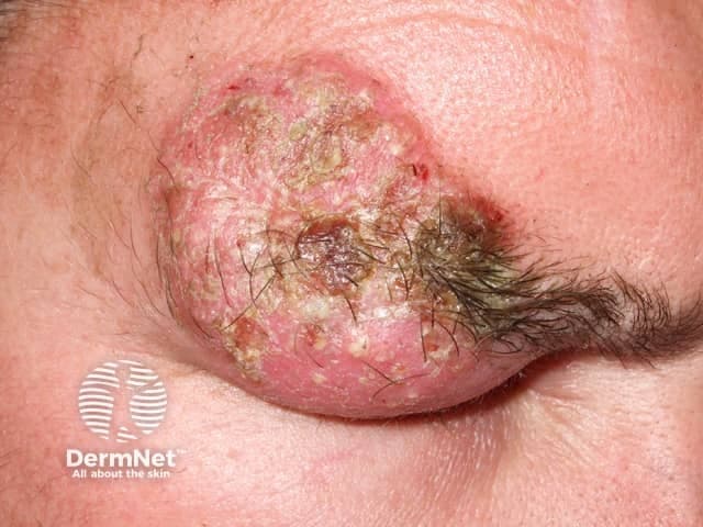 Clinical photography of a scalp lesion consistent with kerion, an inflammatory tinea capitis. Modality: dermatologic photography, close-up, frontal view of the left eyebrow/scalp region. The lesion is a raised, erythematous plaque with conspicuous yellow-brown crusts and surrounding scaling. Central areas show pustules and crusting with focal necrosis potential, and there is hair breakage and non-scarring alopecia at the periphery. The lesion is bilaterally inflamed but focal, with edema of the surrounding dermis producing a boggy, indurated impression. The pattern is unilateral and localized to the frontal-temporal scalp and periorbital area, compatible with fungal infection rather than primarily bacterial. The appearance corresponds to kerion: thick, crusted plaque, painful nodularity, regional lymphadenopathy not visible in image. Dermatoscopic details not applicable; histology would show perifollicular granulomatous inflammation with fungal elements. Clinically, kerion signals active dermatophytosis requiring systemic antifungal therapy and possibly adjunctive topical antifungals, with careful differential from bacterial cellulitis and folliculitis. Early recognition is critical to prevent scarring alopecia. This image, used for medical education, illustrates characteristic features: inflammatory plaque, yellow crusts, scaling perifollicular involvement, and localized hair loss, aiding differential diagnosis, treatment planning, and patient counseling. Note: fungal etiology confirmed by culture or molecular methods guides therapy selection and prognosis monitoring.