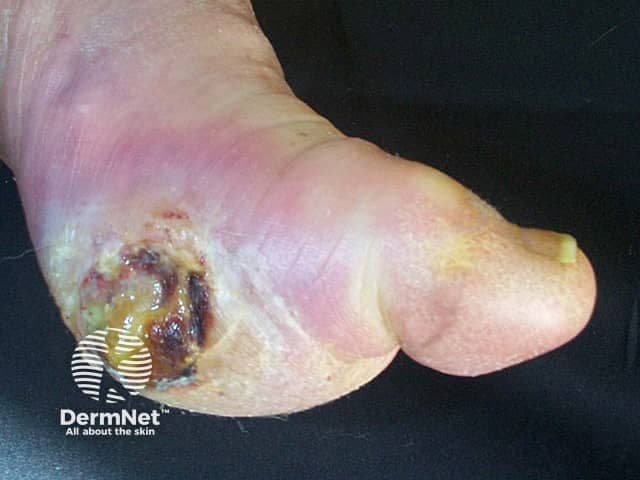 Clinical photograph of a diabetic foot ulcer on the plantar aspect of the foot. Modality and technique: digital clinical photography, macro close‑up, high‑resolution image captured under studio lighting to document wound characteristics. Anatomical location: plantar surface of the midfoot near the hindfoot weight‑bearing area; tissue involved: skin and subcutaneous tissue with an open crater. Visual features: central necrotic base with brown‑black eschar, surrounding yellow slough, irregular wound edges, and periwound edema with mild erythema. Surrounding callus and hyperkeratosis are present on adjacent plantar skin. No visible tendon or bone is apparent in this view. Assessment terms: diabetic neuropathic (neuroischemic) ulcer, chronic non‑healing wound, likely colonized/infected given tissue breakdown. Pathology at the surface includes necrotic tissue, slough, inflammatory exudate, and bacterial colonization risk. Clinical significance: indicates chronic diabetic wound with high risk of infection progression and osteomyelitis if depth is underestimated; requires debridement, offloading, moist wound care, infection control, vascular assessment, and glycemic optimization. Potential clinical uses: baseline assessment, monitoring healing, guiding offloading strategy, educating patient, and planning multidisciplinary management (podiatry, wound care, endocrinology). Synonyms: diabetic foot ulcer, plantar neuropathic ulcer, diabetic plantar wound. Clinical note: assess peripheral pulses, document wound dimensions, and obtain imaging (X-ray/MRI) if osteomyelitis is suspected to guide treatment decisions.