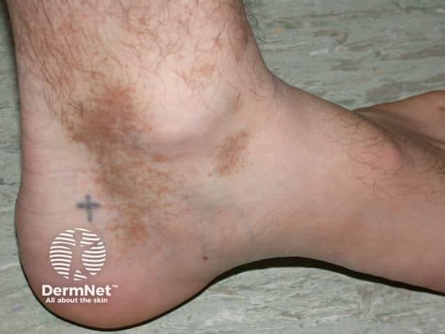 Imaging modality and technique: High-resolution clinical photograph of the left ankle/foot region, color-balanced, macro view. The subject shows multiple hyperpigmented brown patches over the posterolateral ankle and calcaneal region with irregular, slightly scaly borders. The skin between patches appears normal to mildly erythematous without edema. The largest patch spans approximately 2–3 cm in diameter, with peripheral hypopigmented rim in places and variable pigmentation intensity across the patch. The involved skin is otherwise non-edematous, with visible hair follicles and normal surface texture. The lesion distribution is unilateral, confined to the lateral malleolar area, consistent with dermatitis or fungal pigmentary change. No vesicles or pustules are evident. Clinically, this pattern could reflect post-inflammatory hyperpigmentation, tinea (pityriasis) versicolor or dermatophyte infection, or pigmented contact dermatitis. Differential diagnoses include superficial fungal infection (tinea corporis/cruris variant limited to ankle), lichen simplex chronicus with pigment change, stasis dermatitis, or melanosis associated with friction. Correlating history (exposure to humid environments, prior inflammation, trauma, footwear friction) and primary symptoms such as pruritus will guide workup. Useful tests include KOH microscopy, fungal culture, Wood lamp examination, or biopsy if lesions persist or progress. This image documents pigmentary change with potential inflammatory or infectious etiologies, highlighting the need for dermoscopic or microbiologic evaluation and targeted therapy.