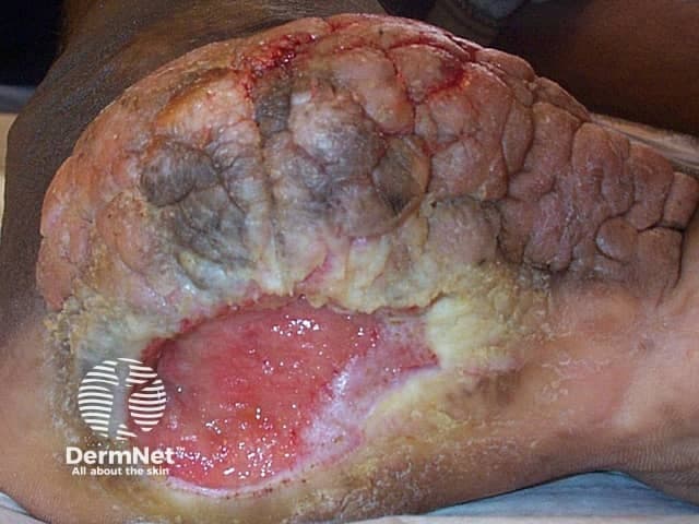 Imaging modality: Clinical photography. Perspective: plantar surface close-up of a chronic neuropathic foot ulcer. Site: plantar midfoot/ball region near the weight-bearing plantar surface of the foot with surrounding callus. Visual features: large, shallow ulcer with a reddened, raw base; yellow-gray necrotic slough rimmed by hyperemic tissue. Surrounding skin shows thickened keratin (callus), fissuring, and mild edema; moisture varies with exudate. The ulcer bed appears to granulate in parts but remains largely necrotic and at risk of secondary infection. No visible intact epidermis over the lesion. Peri-wound area demonstrates crusting and maceration from drainage. The clinical photograph documents a non-healing, neuropathy-associated lesion often seen in diabetes mellitus or peripheral neuropathy; pain is typically reduced, delaying care. In this context, the image highlights pressure-related risk, repetitive friction, and reduced protective sensation contributing to ulcer development. Diagnostic significance: supports diagnosis of a neuropathic (diabetic) plantar foot ulcer; differentiates from ischemic, venous, or pressure ulcers; emphasizes need for off-loading, debridement, moisture balance, infection surveillance, and vascular assessment. Potential uses: medical education, wound-care planning, telemedicine triage, research on wound healing, assessment of treatment response, and algorithm development for neuropathic ulcers. Documentation supports multidisciplinary care, including off-loading devices, infection control, and regular wound monitoring and prognosis.