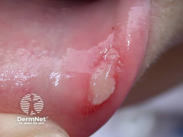 Clinical photography of the lower labial mucosa showing a solitary aphthous ulcer. Imaging modality: intraoral clinical photograph with standard white-light illumination; close-up view; high-resolution. Location: oral cavity, mucosa of the lower lip (labial mucosa) near the vestibule. Appearance: shallow, round-to-oval ulcer with a pale gray-to-yellow floor and a surrounding erythematous halo; mild mucosal edema is evident; bordered margins are distinct. The lesion is non-vesicular; there is minimal exudate and no surrounding necrosis. The specimen type is human oral mucosa; perspective is an anterior-facing close-up. It is compatible with minor aphthous stomatitis (aphthous ulcer), commonly termed canker sore. Differential diagnoses include traumatic ulcer, herpetic gingivostomatitis, erythema multiforme, and candidal ulcer in immunocompromised individuals; clinical correlation with history of oral trauma, stress, nutritional deficiency (iron, B12, folate), or underlying systemic conditions may be required. Typical prognosis is self-limited with spontaneous resolution within 7–14 days; symptomatic relief with topical steroids or protective barriers may be used. Clinically relevant in dentistry, dermatology, oral medicine, and primary care as a common mucosal inflammatory lesion. This image aids education on differential diagnosis, clinical recognition, patient counseling, and management planning. No suspicious features such as ulcerative plaques, vesicles, or necrotic shrouds are evident in this image today.