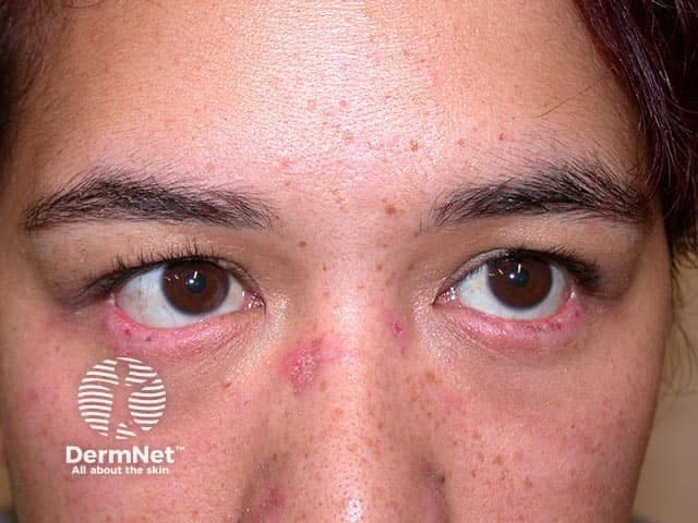 This clinical photograph depicts drug-related photosensitivity affecting the nose and periorbital skin in a patient on amiodarone therapy. Modality: Clinical photography; a frontal close-up view of the face under color-balanced illumination highlights symmetrical erythema around the nasal dorsum and both eyelids with mild periorbital edema. The nasal skin shows diffuse erythema with small papillose papules, consistent with photodistributed dermatitis. The periorbital regions display accentuated redness and edema; surrounding cheek skin is relatively unf­ected. The image demonstrates features typical of amiodarone-associated photosensitivity: sun-exposed cutaneous regions develop erythema, edema, and possible scaling, often bilateral and facially distributed. The clinical significance lies in recognizing drug-induced phototoxicity or photoallergic dermatitis in patients on amiodarone, guiding sun protection, dose assessment, and potential drug substitution. This photograph is relevant for dermatology and pharmacovigilance education, illustrating differential diagnoses such as rosacea-like photodermatosis, contact dermatitis, and lupus-related photodermatosis. Clinically, this supports diagnostic considerations for photosensitive eruptions in the periocular/nasal regions, with implications for monitoring ocular surface irritation, ensuring photoprotection, and coordinating care with cardiology for antiarrhythmic management. The image underscores the importance of documenting drug-induced cutaneous reactions to refine treatment decisions, educate patients on sun avoidance strategies, and alert clinicians to potential ocular complications requiring multidisciplinary management.