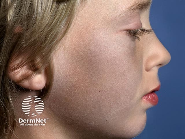 This is a high-resolution clinical photograph (dermatology photography) of the left lateral face focusing on the malar region in a patient receiving long-term amiodarone therapy. The image demonstrates diffuse slate-blue to gray-blue discoloration of sun-exposed facial skin, most prominent on the cheeks and periorbital areas, with relative sparing of hidden folds. The pigmentation is flat and diffusely distributed, without edema, ulceration, or textural change, and appears symmetric across analogous facial sites. The color change is characteristic of amiodarone-induced cutaneous hyperpigmentation, which results from deposition of drug-related lipofuscin-like pigment in the dermis and increased melanin in response to ultraviolet exposure. The clinical significance lies in recognizing a medication-related pigmentary change that correlates with cumulative dose and duration of therapy; it may prompt drug history review and consideration of dose modification or discontinuation if pigment progression or systemic toxicity occurs. Differential considerations include minocycline-induced hyperpigmentation, argyria, or solar lentigines; however, the pattern, distribution, and medication history favor amiodarone. This image is relevant for dermatology education, psychophysical color assessment, and pharmacovigilance case documentation, illustrating drug-induced dermal changes and serving as a visual aid in patient counseling, clinical correlation with hepatic/thyroid monitoring, and research on cutaneous adverse reactions of antiarrhythmic therapy.