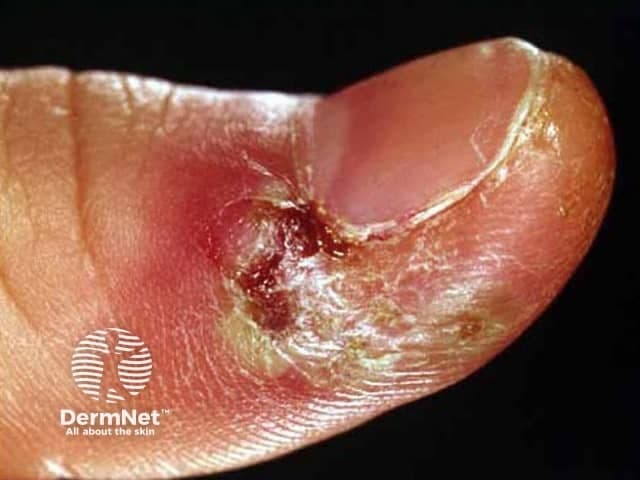 This is a high-resolution clinical photograph in visible light depicting acute herpetic paronychia of the fingernail region. Modality: Clinical photography; technique: close-up, macro view of the nail fold. Anatomical location: digits, paronychia around the nail plate of a fingertip (paronychia at the lateral/lateral nail fold). Appearance: marked erythema and edema of the periungual tissue with surrounding desquamation, crusting and whitish exudate; nearby skin may be tense; central vesicles or pustules may be present but not clearly visible in this frame; the tissue shows vesicular clusters typical of herpes simplex infection; the nail fold fissures and crusts indicate acute inflammatory response; arrangement is unilateral, localized to the lateral nail border. Pathology: HSV-induced vesiculobullous lesions targeting the proximal and lateral nail folds; differential includes bacterial paronychia; differentiation through vesicle groups on erythematous base; clinical features include painful swelling and rapid onset. Diagnostic significance: recognition of herpetic etiology guides antiviral management (acyclovir, valacyclovir) and cautions incision/drainage; may require microbiology confirmation (PCR, Tzanck smear). Clinical use: educational illustration for dermatology training, infectious disease differential, primary care assessment of paronychia; relevant for telemedicine triage; keywords: paronychia, herpes simplex virus, HSV, distal finger infection, periungual edema, vesicles, vesicular lesions, crusting, acute, infectious dermatology.
