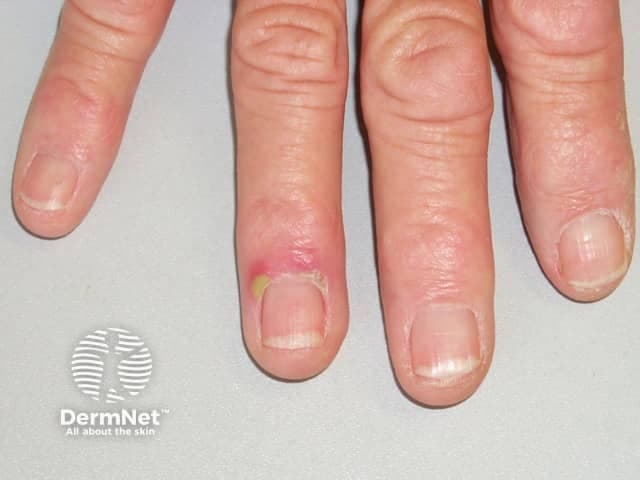 This is a clinical color photograph captured with digital close-up macro technique focusing on the nail unit of the right middle finger. The image documents the proximal nail fold region and surrounding cuticle. Visible findings include marked erythema and edema of the proximal nail fold with a small yellowish pustule/crust at the nail fold base, consistent with acute paronychia. The adjacent nail plate appears structurally normal, with no obvious subungual hematoma or distal nail dystrophy. The presentation is unilateral, localized to the medial digit, and the skin surface over the nail apparatus shows mild surface tenderness suggested by swelling. The lesion demonstrates an inflammatory process that may be secondary to minor trauma, nail-biting, manicuring injury, or moisture exposure, allowing bacterial inoculation. Differential considerations include chronic paronychia, candidal paronychia, herpetic whitlow, and ungual abscess if fluctuation develops. Clinically, the finding is important because early management with warm compresses, topical antiseptics, and antibiotic therapy or incision and drainage if an abscess is present can prevent progression. This image is relevant for dermatology education, hand surgery preoperative assessment, infectious disease case discussions, and clinical teaching on nail-fold infections and their visual differentiation from other nail disorders.