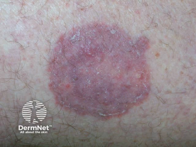 This image is a clinical dermatology photograph of tinea corporis (dermatophyte fungal infection) affecting cutaneous skin. Modality and technique: visible-light clinical photography, macro close-up, standard illumination, no special stains or contrast; acquisition from a superficial skin lesion for bedside documentation. Anatomical context: integumentary system; skin (epidermis/dermis) of the trunk or proximal extremities; localized circular to oval plaque. Visual features: annular erythematous plaque with a well‑defined, active border and central clearing; surface desquamation with fine scale; the border may appear slightly raised and pruritic in vivo; hue ranges from pink to violaceous in inflammatory areas; surrounding hair and adjacent skin show mild irritation without deep tissue involvement. Pathology/diagnosis signals: the classic ring-shaped lesion with central clearing is characteristic of tinea corporis; clinical impression supported by dermatophyte infection of keratinized tissue; laboratory confirmation may show hyphae on potassium hydroxide (KOH) preparation or positive fungal culture; histopathology shows hyperkeratosis and fungal elements in stratum corneum when biopsy is performed. Diagnostic significance and utility: high clinical probability for dermatophyte infection guides antifungal therapy; differential includes nummular dermatitis, psoriasis, granuloma annulare, pityriasis rosea; treatment implications include topical agents (terbinafine, naftifine) or systemic therapy for extensive disease; infection is contagious and may require contact precautions.