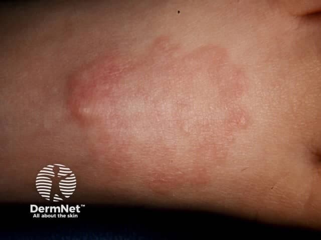 Imaging modality: Clinical photography of a cutaneous lesion. Technique: Standard color digital close-up, macro-equivalent view to capture surface texture and contour. The image depicts a single annular plaque on the limb skin (likely forearm). The lesion shows a circular to oval ring with central clearing, a pink-to-pale erythematous border, and a smooth, non-ulcerated surface. Outer rim may be slightly raised or indurated; surrounding skin is otherwise normal. Size is not quantified in the image. Color and pattern are characteristic of granuloma annulare, though biopsy is required for definitive histology. The differential diagnosis for annular plaques includes tinea corporis, erythema annulare centrifugum, subacute cutaneous lupus erythematosus, annular psoriasis, and other granulomatous dermatoses. Clinically, granuloma annulare is a benign, usually asymptomatic or mildly pruritic inflammatory dermatosis that presents as solitary or concentric rings, most commonly on extremities. Histopathology (not seen in image) typically demonstrates necrobiotic collagen in the dermis with palisading histiocytes and a sparse inflammatory infiltrate. Diagnostic significance lies in distinguishing GA from infectious mimics and inflammatory dermatoses to guide management. Clinically, this image is useful for dermatology education, differential diagnosis training, and tele-dermatology reference, with treatment tailored to symptom burden and extent. Clinical use includes documentation, patient counseling, and follow-up assessment.