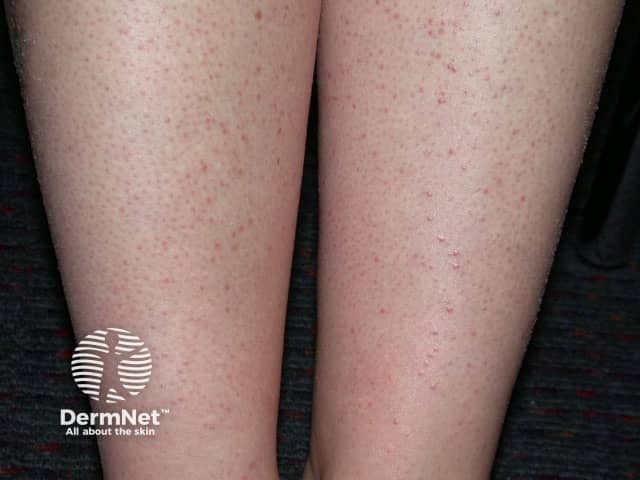 Clinical photography of exposed lower legs demonstrates a diffuse eruption consistent with folliculitis secondary to hair removal. The images depict bilateral shins with numerous small, erythematous papules and scattered pustules centered on hair follicles, surrounded by mild perifollicular erythema. The lesions are superficial and discrete, without obvious abscess formation or systemically abnormal findings. Hair shafts appear present; irritation and microtrauma from shaving or waxing likely initiated the perifollicular inflammation. The pattern is predominantly follicular, with a uniform distribution along anterior leg surfaces, suggestive of irritant contact folliculitis rather than a deep infectious process. The skin surface shows no crusting beyond minor scale in some papules, consistent with mild inflammatory response. In the clinical context, this presentation aligns with post-hair-removal folliculitis and may resolve with conservative management or topical antiseptics, exfoliation, and avoidance of aggressive hair removal. Secondary bacterial infection should be considered if pustules enlarge or purulence increases, warranting antibiotic therapy. The image serves as an educational reference for recognizing common dermatologic sequelae of depilation techniques and for differentiating folliculitis from keratosis pilaris, acneiform eruptions, or contact dermatitis. It supports patient counseling on shaving methods, skin prep, and timely treatment.