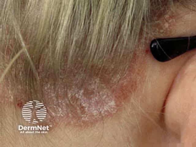 Clinical photography of dermatologic disease. This is a close-up, lateral view of the posterior neck and occipital scalp near the hairline, showing erythematous, well-demarcated plaques with thick, silvery scales consistent with active plaque psoriasis. Lesions extend along the nuchal region and behind the ear, with mild induration and irregular borders in places. The skin surface exhibits adherent scale and subtle fissuring; surrounding skin is relatively normal. The color is red-erythematous with a metallic sheen from the scales, and there is minimal lichenification. This plaque morphology—sharply demarcated erythematous plaques with overlying silvery scale—reflects classic psoriasis pattern, commonly seen on scalp, neck, and extensors. No pustules or erosions are evident. The image demonstrates typical disease distribution in the head and neck area and highlights the keratotic scale with underlying epidermal hyperplasia. Clinically, this appearance supports the diagnosis of plaque psoriasis; differential considerations include seborrheic dermatitis, atopic dermatitis, tinea capitis/corporis, and pityriasis rosea in variant presentations. Diagnostic significance lies in recognizing plaque psoriasis morphology for treatment planning, including topical corticosteroids or vitamin D analogues, calcineurin inhibitors in selected cases, and consideration of phototherapy for extensive disease. Educationally, this image aids lesion recognition, distribution mapping, and patient counseling. It is suitable for teaching reference.