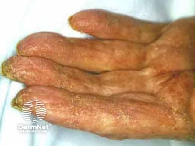 Imaging modality and technique: Clinical photography of a human hand, macro close-up to document surface skin changes. Primary subject: Scabies infestation presenting as inflammatory skin lesions on the hands. Specimen type: Human epidermis with superficial dermal involvement. Imaging perspective: Anterolateral view of the fingers with emphasis on interdigital spaces and palmar surfaces. Comprehensive description: The image shows erythematous, scaly plaques with rough, crusted areas on multiple fingers and the palmar surface. Sparse vesicles and papules may be present, with visible fissuring in interdigital folds. The texture appears thickened and pruritic‑appearing, consistent with inflammatory dermatitis secondary to Sarcoptes scabiei infestation. Burrow tracks are not clearly seen, but linear or serpiginous markings may be suggested by subtle skin creases. The distribution over web spaces and finger shafts aligns with common scabies localization, particularly in the hands, which are a typical anatomic site for mite transfer. Diagnostic significance: In the appropriate setting of nocturnal itching and exposure to an individual with similar symptoms, this cutaneous pattern supports scabies and prompts diagnostic confirmation by skin scrapings, dermoscopy, or microscopic identification of mites, eggs, or fecal pellets. Differential considerations include eczema/dermatitis, contact dermatitis, psoriasis, or tinea manuum. This image aids education, patient counseling, and decision making regarding topical scabicides or oral ivermectin therapy.