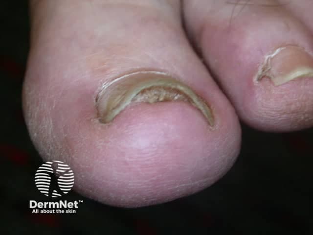 Clinical photography of a dystrophic toenail. Modality: high-resolution close-up digital photograph of the great toe nails in dorsal orientation. Location: toenail unit, plantar/dorsal aspect, with visible nail plate and distal edge. The image demonstrates thickened, yellow-brown discolored nail plate with a rough, crumbly surface and subungual keratinous debris. A crescent-shaped band of discoloration along the inner edge of the distal nail bed is evident, consistent with onychomycosis. Mild onycholysis at the distal margin may be present. Periungual skin appears uninflamed without surrounding erythema. Observed pattern suggests Ungual candidiasis? No; treat as dermatophyte infection. Overall features are typical of tinea unguium (onychomycosis) with nail plate dystrophy and subungual hyperkeratosis. Clinically significant as fungal nail infection that can cause nail thickening, discomfort, and cosmetic concern. Diagnostic significance: supports clinical suspicion of onychomycosis; differential includes nail psoriasis, lichen planus, trauma. Diagnostic workflow would include KOH prep, fungal culture, or PCR to confirm dermatophyte infection. Potential clinical uses include education, tele-dermatology triage, and guiding antifungal therapy decisions (systemic vs topical) with follow-up assessment. This image is suitable for teaching nail anatomy, pathology, and infection patterns in dermatology. Its simplicity aids rapid recognition in primary care and remote consultations.