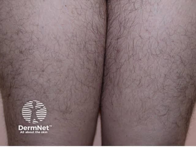 Clinical photography of bilateral anterior-medial thighs at close range, using high-resolution imaging to document healthy skin texture and hair pattern. The image shows the integumentary system in the thigh region with frontal/anterior view and a neutral lighting scheme. Visual features include even skin tone, fine vellus hair density, uniform epidermal surface, and absence of erythema, scaling, plaques, vesicles, ulcers, crusting, edema, or nodules. No focal lesions or pigmentary abnormalities are evident. The regional anatomy corresponds to the anterior medial thigh with subtle skin folds and intertriginous contact areas. There are no signs of inflammation, infection, or trauma in this field of view. This photograph provides a baseline reference for normal cutaneous appearance in the groin/upper thigh area and can be used for comparison with dermatologic conditions such as dermatitis, tinea cruris, candidiasis, intertrigo, psoriasis, pityriasis, or malignant lesions when present. Diagnostic significance lies in establishing a normal skin phenotype for this region, aiding differential diagnosis and clinical correlation in patients presenting with pruritus or rash. Potential uses include medical education, image database curation, and development of computer vision tools for healthy-skin recognition and anomaly detection in dermatology. This baseline image supports reproducible comparisons across clinicians and educational contexts for training.