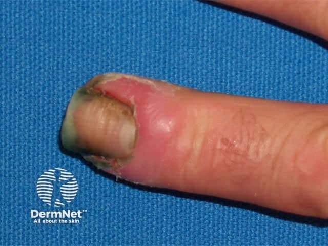 Comprehensive Description: A high-magnification clinical photograph of a single fingernail demonstrates chronic paronychia affecting the periungual region. The image captures the dorsal-lateral aspect of the distal finger, highlighting erythema and edema of the lateral nail fold with fissuring and crusting at the cuticle. The nail plate is partially displaced by surrounding inflammation, and there may be mild hypertrophy of the proximal nail fold. These findings reflect a protracted inflammatory process often linked to repeated moisture exposure, trauma from manicure practices, irritant contact, or candidal colonization. The visual features include localized redness, tenderness, soft tissue swelling, and occasional crusted debris at the cuticle; the adjacent skin appears thickened in places. Clinically, this presentation suggests chronic paronychia rather than an acute infection, and a clinician would consider secondary fungal or bacterial involvement, eczema, or psoriasis of the nail unit in the differential. The diagnostic significance lies in guiding management toward topical or systemic anti-inflammatory therapy, barrier protection, meticulous nail hygiene, and targeted antimicrobial or antifungal treatment when indicated. This image is valuable for dermatology education, clinical case assessment, and comparative studies of nail-fold inflammation or chronic paronychia progression. Early recognition improves outcomes through targeted therapy and preventive hand care for patients daily.
