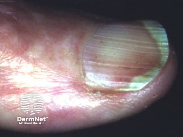 This is a high-resolution clinical photograph of a human fingernail demonstrating koilonychia, also called spoon nails. Imaging modality is clinical photography with macro/close-up technique to enhance surface and curvature details. The primary subject is the fingernail plate and surrounding nail folds, captured from a dorsal perspective for clear visualization of the nail curvature. The nail plate appears thin and concave, with a pronounced central depression producing a spoon-shaped contour. Lateral edges may be slightly tapered, and the distal third of the plate shows mild translucency. The surface is relatively smooth with minimal ridging, and the lunula is less conspicuous in this view. Surrounding cuticle and perionychial skin show mild erythema, possibly secondary to manipulation or irritation; no frank edema or pitting is evident. Clinically, koilonychia is a classic morphological clue associated with iron deficiency anemia and other nutritional or systemic disorders; in many cases nails become spoon-shaped due to chronic iron depletion. The diagnostic significance lies in recognizing a potentially reversible sign when iron stores are restored. This image is useful for dermatology, medical education, nursing training, and clinical scenario discussions focused on anemia screening, differential diagnosis of nail dystrophies, and patient education about nail changes as a diagnostic cue. Consider correlating with CBC and ferritin, and monitoring response to iron therapy.