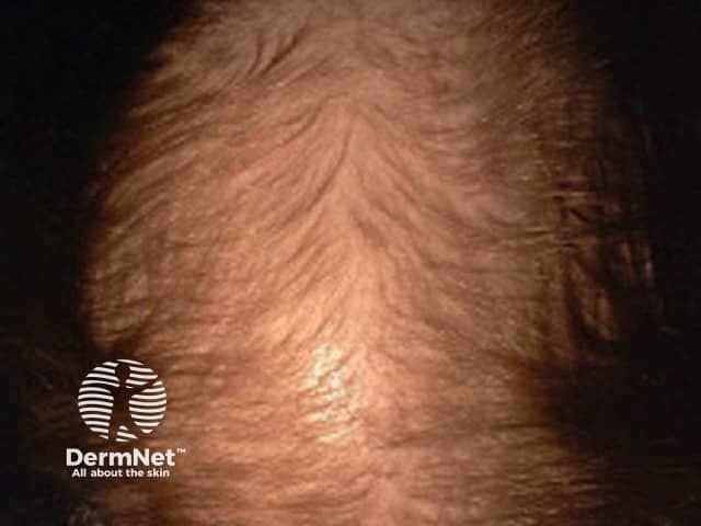 Clinical photography of the scalp in color (frontal-vertex view) illustrating female pattern alopecia. Primary subject: female pattern hair loss (androgenetic alopecia) in an adult patient. The image shows vertex-predominant thinning with the frontal hairline largely preserved. Hair density is reduced across the central scalp, with perifollicular thinning and apparent miniaturization resulting in finer, shorter hairs in affected regions. The occipital and temporal areas appear comparatively less involved. Overall pattern is typical for female pattern hair loss: diffuse, bilateral thinning with a central partition and crown involvement, often progressing gradually. The scalp skin demonstrates no scarring, inflammation, or pigmentary changes; there is no visible scarring alopecia. No magnification or dermoscopic technique is depicted. This photograph is valuable for education on androgenetic alopecia, assisting differentiation from telogen effluvium, alopecia areata, and other non-scarring alopecias when combined with history. It supports clinical diagnosis, informs prognosis, and aids in patient counseling about therapeutic options and expected outcomes. For research and teaching, the image serves as a representative example of typical FPHL pattern, enabling pattern recognition, grading of density changes, and longitudinal assessment after treatment or hormonal interventions. Any accompanying image metadata should include patient age range, photo date, and equipment used for reproducibility standards.