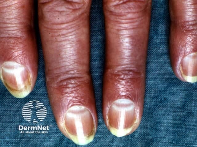 Clinical photography of the nails demonstrating Muehrcke lines. Anterolateral view of several fingernails (index, middle, ring, and little fingers) on both hands. The nail plates show paired, parallel, transverse white bands crossing the lunula region and extending toward the distal edge. These lines are non-palpable and lie within the nail bed/plate interface, giving the appearance of alternating light bands against the surrounding pinkish nail bed. The bands do not accompany surface textural changes and disappear with recovery of serum albumin; they are not true leukonychia. The finding is best explained by hypoalbuminemia leading to edema of the nail bed and reduced capillary perfusion, producing transverse opacities. Associated clinical context includes liver dysfunction, nephrotic syndrome, malnutrition, inflammatory states, or protein loss; systemic edema may be present. Distinguish from Beau lines (transverse ridges within the nail plate from growth arrest) and Mees’ lines (arsenic poisoning) which are embedded in the nail plate rather than the nail bed. This image underscores the dermatologic sign’s diagnostic significance as a noninvasive clue to systemic protein deficiency. Potential clinical use cases include screening for hypoalbuminemia in hospitalized patients, monitoring nutritional status in malnourished individuals, and differential diagnosis of white nail banding in clinical dermatology in practice.
