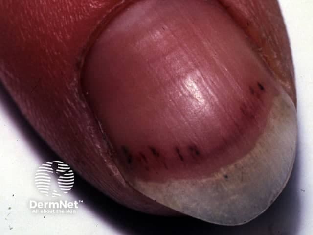 Imaging modality: Clinical close-up photography of the distal fingernail, captured with macro focus. The image shows a single fingernail with several slender, parallel splinter hemorrhages along the ventral edge of the nail bed. The hemorrhages appear as linear, red-brown to purplish streaks aligned with the longitudinal axis of the nail, extending proximally from the distal nail plate. Subungual microhemorrhages indicate capillary blood extravasation with otherwise intact surrounding tissue. The adjacent nail matrix and lunula appear non-edematous and without overt dystrophy or paronychia in this view. The pattern is characteristic of splinter hemorrhages and can result from minor trauma, vascular fragility, or microembolic phenomena. When multiple nails are involved or if systemic signs are present, differential considerations broaden to infectious endocarditis, vasculitis, autoimmune disease, or platelet/coagulation disorders. Clinically, splinter hemorrhages warrant correlation with history, cardiovascular examination, and, if indicated, cardiac imaging or laboratory evaluation. In educational settings, this image illustrates nail unit anatomy and the appearance of subungual hemorrhages, aiding dermatology, internal medicine, and medical microbiology teaching. The finding is not pathognomonic but serves as a meaningful clinical clue within a broader diagnostic framework. This image supports reproducible teaching and standardized exam prompts.