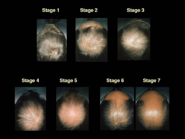 Clinical photography depicting a staged sequence of male pattern hair loss on the vertex and crown regions, illustrating Norwood-Hamilton stages 1 through 7. The modality is photography, captured in top-down views with uniform lighting to document progressive scalp thinning and hair shaft miniaturization in an adult male. The primary subject is androgenetic alopecia, with a gradual increase in scalp visibility, decrease in hair density, and widening of the distal hair shaft diameter as stages advance. Stage 1 shows minimal recession with intact vertex area; Stage 2-3 demonstrates mild to moderate thinning at the vertex; Stage 4-7 shows extensive balding with marked crown thinning and temple recession. The images emphasize non-scarring, non-inflammatory hair loss without visible scarring or perifollicular erythema. Clinically this pattern is highly characteristic of hereditary male pattern baldness, linked to androgen sensitivity and genetic predisposition. Diagnostic significance lies in providing a visual framework for staging, prognostication, and treatment planning. Differential considerations include telogen effluvium, diffuse alopecia, and traction alopecia, though these typically lack the symmetrical vertex-dominant pattern. The montage is valuable for dermatology education, patient counseling, and research on pharmacologic responses to finasteride, dutasteride, or topical minoxidil, as well as for quantitative hair density assessments and longitudinal monitoring.