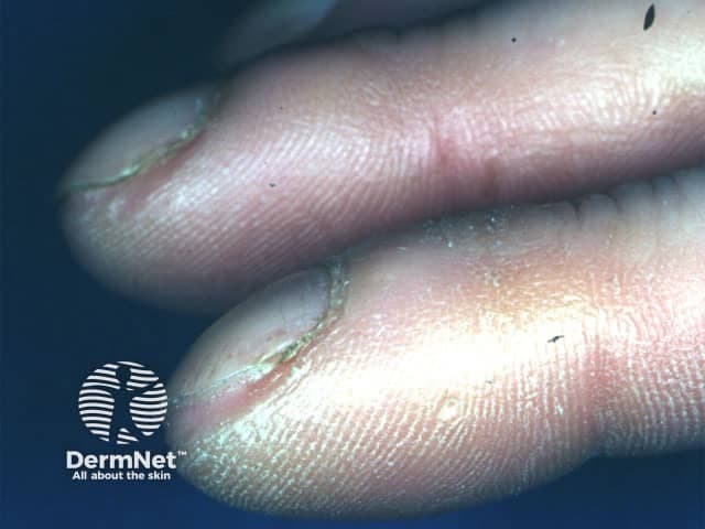 Clinical photograph of the distal digits demonstrating digital clubbing. Modality: Clinical photography; technique: macro close‑up digital image with bright‑field illumination and high resolution to emphasize nail bed morphology. Anatomical location: fingers (distal phalanges) with visible nail plates, nail beds, and periungual tissue; dorsal view highlighting the nail–bed interface. Visual features: bulbous, expanded distal digits; nail plates show increased curvature with convex nail beds; reduced angle between the nail plate and the adjacent skin; glossy, smooth periungual skin; absence of cutaneous ulcers in view; subtle subungual fullness may be present. Pathologic/clinical findings: clubbing is a clinical sign characterized by hyperplastic nail bed change; not a histologic lesion, but correlates with chronic hypoxia and systemic disease. Diagnostic significance: digital clubbing signals potential underlying cardiopulmonary pathology or hepatobiliary disease; commonly associated conditions include interstitial lung disease (idiopathic pulmonary fibrosis, bronchiectasis), chronic obstructive pulmonary disease, cyanotic heart disease, liver cirrhosis, and inflammatory bowel disease; warrants systemic workup. Differential considerations: idiopathic clubbing; secondary clubbing from pulmonary/vascular disease or congenital heart disease; alternatively pseudoclubbing from nail dystrophy. Clinical correlation: correlate with oxygen saturation, chest imaging, echocardiography, hepatic panel; multidisciplinary assessment recommended. Documented progression can guide treatment decisions and patient counseling in dermatology, pulmonology, and internal medicine.