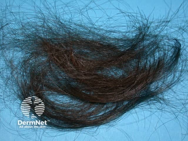 Imaging modality: Clinical photography; macroscopic close-up of hair fragments collected from the scalp to illustrate anagen effluvium. Primary subject: Hair shafts showing abrupt shedding during the anagen phase. Specimen: Hair sample (scalp) arranged on a blue background for contrast. Perspective: Macroscopic, top-down view focusing on hair shaft morphology. Anatomical location: Scalp hair shafts as the source of the specimens. In terms of technique, high-resolution digital photography was used with diffuse lighting to minimize glare; no staining or contrast agents were applied. Magnification: Macro level (approximately 2–5x) to reveal hair shaft integrity and cuticle; acquisition parameters not provided. Observed features: Dark, bundled hair shafts with varying lengths, some with abrupt ends and frayed cuticles; minimal to no root visible. The sample demonstrates a rapid shedding pattern typical of anagen effluvium. The image documents anagen effluvium—a rapid loss of growing hair often linked to chemotherapy or toxin exposure. Notable features include uniform shedding of anagen hairs with preserved follicular openings and minimal inflammation on the specimen level. Diagnostic significance: Supports diagnosis of drug-induced hair loss and distinguishes from telogen effluvium or alopecia areata. Differential considerations: Telogen effluvium, chemotherapy-related damage, radiation-induced hair loss. Clinical correlation: Useful in dermatology, oncology, and trichology to assess severity, monitor response to cytotoxic therapy, and guide counseling.