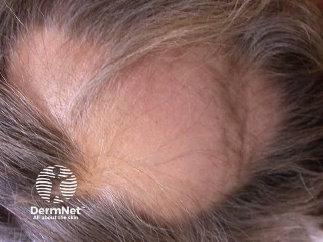 This is a high-resolution clinical dermatology photograph of the scalp, captured with standard white-light illumination, showcasing a single well-demarcated alopecic patch on the left scalp (parietal/vertex region). The lesion measures several centimeters in diameter, with complete hair loss in the central area and preserved surrounding skin. The surface is smooth, non-erythematous, and non-scaly, with a soft, nonwarty border; no scarring or perifollicular hyperkeratosis is evident in this view. The appearance is most consistent with non-scarring alopecia such as alopecia areata (autoimmune) rather than tinea capitis or cicatricial processes. Hair shafts at the margin are diminished but follicles are not destroyed. The differential diagnosis includes alopecia areata, tinea capitis, traction alopecia, and less likely discoid lupus erythematosus. Clinically, alopecia areata commonly presents with sudden onset patchy hair loss and may have associated other patches or autoimmune conditions. In prognostic terms, this presentation can spontaneously remit or progress to additional patches; response to corticosteroids or immunomodulators is variable. This image is relevant for clinical education, differential diagnosis training, telemedicine triage, and research datasets focusing on patchy non-scarring alopecia. Useful for students learning recognition of alopecia areata versus fungal or scarring alopecias. Clinical photography like this supports teledermatology workflows and image-based learning modules.