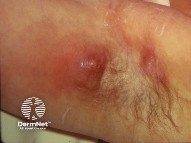 Clinical photograph of axillary skin demonstrating hidradenitis suppurativa (HS) in an apocrine-bearing region. The image shows a localized, inflamed erythematous nodular lesion with a raised, indurated border and a central fluctuant core suggestive of abscess formation. Surrounding skin exhibits mild edema and post-inflammatory changes, including hyperpigmentation and superficial crust. Hair follicles are visible at the periphery and there may be faint sinus tracts or scarring extending laterally toward surrounding axillary folds, consistent with chronic HS. The presentation is typical for HS of the axilla: recurrent, painful nodules that may ulcerate, discharge purulent material, and heal with scarring. The lesion site corresponds to the axillary region (apocrine gland-bearing area) within the integumentary system; this condition commonly involves both axillae but can be unilateral in early stages. Clinically, HS presents as a spectrum from tender papules and boils (furuncles) to draining sinus tracts and fibrotic plaques (Hurley stage II–III). Differential diagnoses include folliculitis, furunculosis, epidermal cyst, and simple abscess; risk factors include obesity, smoking, and metabolic syndrome. Management implications include anti-inflammatory and antibiotic therapy, surgical considerations for refractory disease, and potential biologic agents; this image is educational for recognizing HS features and differentiation from mimics in dermatology and medical education.