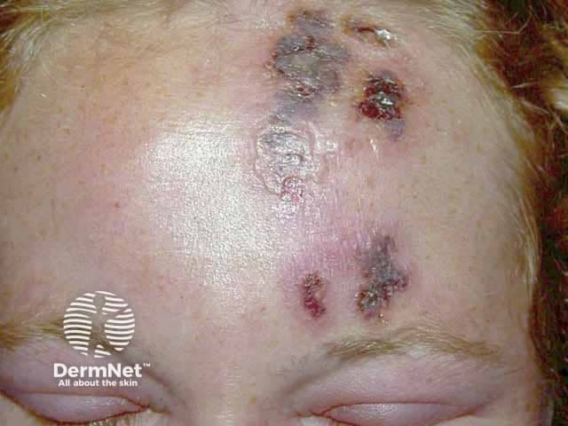 Clinical photograph demonstrating herpes zoster (shingles) involving the ophthalmic division (V1) of the trigeminal nerve in an HIV-positive patient. The frontal skin of the forehead shows clustered vesicular lesions on an erythematous base with crusted erosions, most prominent near the distribution axis along the V1 dermatome, including the glabellar region and the superior eyelid. The eruption is unilateral and dermatomal, with vesicles grouped in a vesicular-rash pattern and surrounding edema. Superficial crusts indicate healing lesions; some vesicles appear partially collapsed. In immunocompromised hosts, including persons living with HIV, zoster may present with more extensive, disseminated, or atypical cutaneous involvement; caution for potential ocular involvement (herpes zoster ophthalmicus) and corneal risk, uveitis, or lid swelling. The clinical appearance is characteristic of varicella-zoster virus reactivation within the trigeminal nerve territory; differential diagnosis includes herpes simplex infection, impetigo, contact dermatitis, dermatitis herpetiformis, and cellulitis. Timely antiviral therapy (acyclovir, valacyclovir, or famciclovir) and HIV management optimize outcomes and reduce postherpetic neuralgia risk. This image is intended for educational illustration of zoster dermatomes patterns, HIV-associated immunosuppression effects on cutaneous viral infections, dermatology teaching, and clinical decision support in infectious disease and ophthalmology contexts. Recognize signs early to prevent complications and optimize antiviral management in HIV.
