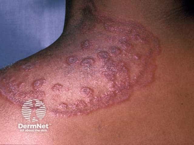 This image depicts a dermatology clinical photograph of tinea circinata (tinea corporis) involving the left shoulder/upper deltoid region in a patient with HIV infection. The modality is clinical photography; color-rendered skin tones demonstrate multiple annular, centripetally expanding plaques with raised, scaly, erythematous borders and central clearing. Lesions display discrete circular to oval morphology, with concentric rings in some plaques and variable postinflammatory hyperpigmentation at perilesional skin. The distribution is localized to the shoulder region, with superficial involvement of the epidermis and superficial dermis. The classic ring-shaped pattern, peripheral scale, and itch-scratch cycles are characteristic. In HIV-associated immunosuppression, dermatophytoses can be extensive, recurrent, or atypical in distribution; secondary bacterial colonization or satellite lesions may occur. The image highlights the differential diagnosis of nummular eczema, plaque psoriasis, pityriasis rosea, and granulomatous fungal infections; correlates with clinical history of pruritus and exposure. The diagnostic significance lies in recognizing dermatophyte infection requiring topical antifungals and/or systemic therapy in immunocompromised hosts. Potential clinical use cases include education on fungal skin infections in HIV, dermatology exam prep, and research on opportunistic dermatophytoses. The finding underscores the need for fungal culture or KOH microscopy to confirm dermatophyte species and guide therapy.