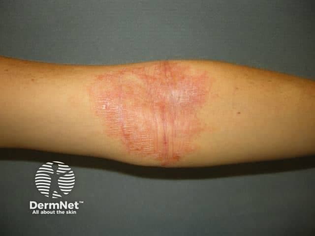 Clinical photography of an inflammatory dermatosis involving the forearm. Imaging modality: standard digital dermatology photograph. The primary subject is human skin with erythematous, edematous plaques demonstrating fine surface scaling and lichenification consistent with atopic dermatitis (eczema). Lesions are localized to the ventral forearm with a slightly linear distribution and central clearing absent. The skin appears mildly dry with fissuring in fissures near the flexural creases. Color variation includes bright red patches interspersed with pale desquamation. The pattern is typical of inflammatory dermatitis rather than infectious etiologies, though secondary infection cannot be excluded without clinical history. The image captures typical features: pruritic rash, chronic scratching marks, layering of erythema, and xerosis. In a clinical setting, this presentation supports a diagnosis of atopic dermatitis or eczema flare, particularly in patients with personal or family history of atopy, asthma, or allergic rhinitis. Differential diagnoses include contact dermatitis, seborrheic dermatitis, psoriasis, tinea corporis, or nummular eczema. Diagnostically, the image is useful for educational purposes, for documenting disease severity, and for correlating with treatment response to emollients and topical corticosteroids. This photographic record aids trainee clinicians in recognizing pattern recognition of eczema and in differentiating from other inflammatory dermatoses. Images support diagnosis, education, patient guidance.