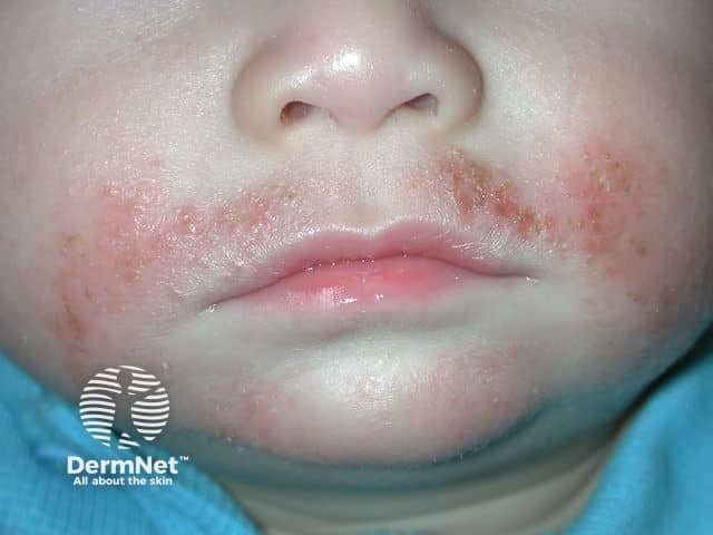 Clinical dermatology photograph of a pediatric patient demonstrates perioral and malar facial involvement consistent with atopic dermatitis (eczema) complicated by secondary Staphylococcus aureus infection. Modality and technique: noninvasive clinical photography, frontal close-up view of the lower face to document surface changes, crusting, and distribution; no staining or contrast. Anatomical context: integumentary system; skin of the cheeks and perioral region; bilaterally symmetric involvement with inflammatory erythema, scaling, and excoriations. Visual features: erythematous papules and plaques with golden-yellow crusts over the vermilion border and adjacent cheeks; superficial fissuring and oozing are evident; skin texture appears rough with edema and surrounding dry patches. Pathological findings (clinical): secondary bacterial colonization with Staphylococcus aureus on compromised atopic dermatitis skin, leading to impetiginous crusts; may show mild edema and superficial pustules; no overt necrosis or lymphangitis seen in image. Diagnostic significance: presence of secondary infection increases risk of spreading, prolongs inflammation, and necessitates antibiotic therapy and intensified skin care; supports diagnosis of infected atopic dermatitis rather than isolated dermatitis. Differential considerations: uncomplicated eczema, impetigo, contact dermatitis with bacterial colonization, or eczema herpeticum to be ruled out clinically. Clinical correlation: guide treatment decisions including topical antibiotics (mupirocin/fusidic acid) depending on severity, antiseptic cleansing, barrier emollients, and follow-up to assess resolution.