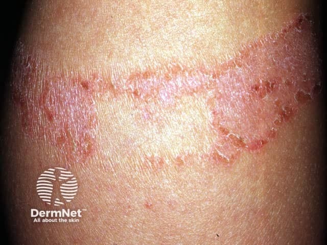 Clinical photograph depicting an adhesive plaster reaction (adhesive tape dermatitis) on exposed forearm skin. The image shows a linear, well-demarcated erythematous plaque with scaling and mild edema along the bandage outline. Peripheral papules and crusting are present, reflecting an inflammatory skin response to adhesive components. The pattern is predominantly contact-mediated and follows the applicator margin, consistent with irritant contact dermatitis or allergic contact dermatitis to plaster ingredients such as acrylates, rubber additives, or latex. There is no purulence or overt infection; warmth and systemic signs are absent. The lesion is superficial, mainly involving the epidermis with possible shallow dermal involvement, and may improve with removal of the offending adhesive. This image is diagnostically helpful for recognizing contact dermatitis from dressings, differentiating from infection (cellulitis), chronic eczema, or psoriasiform eruptions, and guiding patch testing decisions. Clinically relevant terms include contact dermatitis, irritant dermatitis, allergic dermatitis, adhesive allergy, bandage reaction, and dermatitis limited to a band. Educationally, the photo illustrates lesion morphology, distribution pattern, and resolution trajectory after allergen avoidance. In practice, this aids patient counseling, selection of hypoallergenic tapes, topical corticosteroids, and barrier protection to prevent recurrence in future dressings. Careful adhesive avoidance reduces recurrence. Follow-up with moisturizers and barrier films may promote healing.