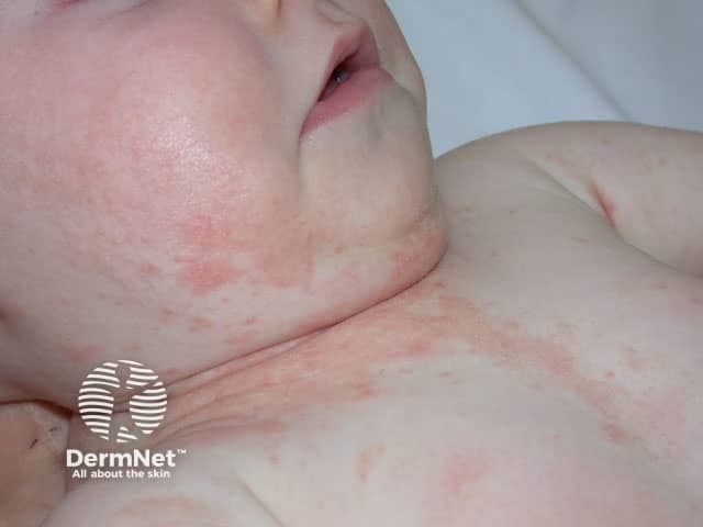 Clinical photograph of neonatal skin showing erythematous, patchy rash localized to the anterior neck folds and spread onto the upper chest. The image captures a close-up frontal view with high color fidelity, natural skin tone, and diffuse lighting. The lesions appear as pink to red, ill‑defined macules and patches without obvious vesicles, crusting, or purulent exudate. Skin elsewhere looks well hydrated, with mild transient erythema at the fold lines where creases may trap moisture. No fever or systemic signs are evident in the image, and there is no obvious edema. Pattern suggests involvement of flexural surfaces in infancy, a common presentation for inflammatory dermatitis. Differential diagnoses include irritant contact dermatitis from saliva, drool, or clothing friction; infantile atopic dermatitis (eczema) with predilection for cheeks, scalp, trunk, and neck folds; miliaria rubra (heat rash) in warm environments; seborrheic dermatitis with erythema; and less likely candidal intertrigo in skin folds. The image provides educational value for recognizing cutaneous inflammatory patterns in newborns and supports clinical correlation with history, timing, irritant exposure, and family atopy. Not a stand-alone diagnosis; should be integrated with physical examination and, if lesions persist or worsen, dermatology referral and follow-up. This description improves searchability for dermatology education resources.