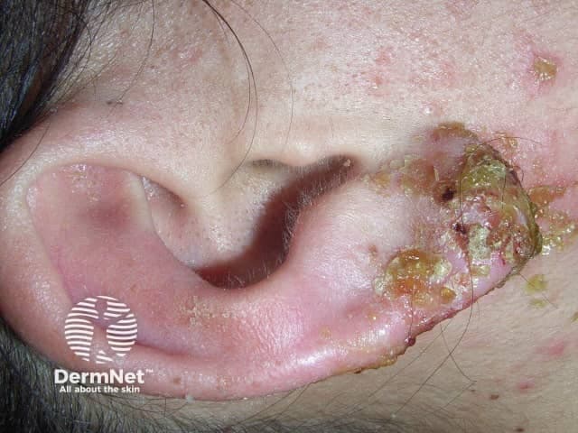 Imaging modality: Clinical photography. Technique: High‑resolution close‑up macro image of the left auricle. This dermatologic photograph documents an infected ear piercing with inflammatory skin changes around the earlobe. Anatomical site is the left external ear (pinna) with focal involvement of the earlobe and peripiercing tissue. Visual features include marked erythema and localized edema, yellow‑brown crusts and purulent exudate, superficial erosions, and flaking desquamation. The piercing tract is inflamed; surrounding skin is tender. There is no obvious deep cartilage involvement in this image, though deep infection cannot be excluded without clinical examination. The appearance is compatible with acute bacterial folliculitis or cellulitis secondary to piercing, with Staphylococcus aureus and Streptococcus species among common pathogens; allergic contact dermatitis to metal is also in consideration. Differential diagnosis includes perichondritis, cellulitis, dermatitis from jewelry, and foreign body reaction. Clinically relevant observations include disruption of skin integrity, risk of abscess formation, and potential progression to cartilaginous infection if untreated. Diagnostic significance lies in guiding immediate management: remove offending jewelry, perform gentle cleansing, consider topical antiseptics or oral antibiotics, assess for systemic symptoms, and refer if cartilage involvement is suspected. This image is educational for dermatology, wound care, and clinical triage. Useful for teaching and triage.