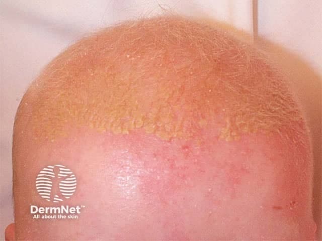 Clinical photograph of the scalp showing seborrheic dermatitis. Imaging modality: clinical photography; frontal view of the scalp illustrating diffuse erythema with greasy yellow scales along the hairline and at the vertex. Affected skin is reddened, slightly inflamed, with adherent scales that are thicker where hair density is highest; no scarring or focal crusting observed. The lesion distribution is scalp-dominant, commonly bilateral and symmetrically distributed across crown and frontal regions, with mild pruritus reported in many cases. Hair shafts appear normal; no alopecia is evident in this image, though chronic disease can cause temporary shedding. The pattern is characteristic: progressive, oily scale-covered plaques on sebaceous-rich skin, often with intermittent flares and scaling at the forehead and behind the ears. Histopathology, if obtained, would typically show superficial perivascular dermatitis with parakeratosis and spongiosis; however, diagnosis here is clinical. Diagnostic significance: seborrheic dermatitis is a common, benign inflammatory dermatosis linked to Malassezia species and sebaceous activity; management relies on antifungal shampoos (ketoconazole, selenium sulfide, zinc pyrithione), topical anti-inflammatory agents (low-potency corticosteroids or calcineurin inhibitors), and regular skin hygiene. This image is useful for education, differential diagnosis training, and guiding treatment responses in primary care and dermatology settings. Correlation with patient history improves diagnostic confidence.