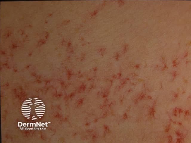 Clinical photography of the cutaneous surface reveals multiple spider telangiectases (spider angiomas) on the trunk. The lesions are characterized by central arteriolar dilation with radiating fine capillaries, producing a red, star-like or spider-web appearance. These blanch with pressure and tend to be bright red to pink. This pattern is typical for telangiectatic cutaneous vascular lesions and is commonly associated with estrogen-dominant states, pregnancy, hormonal therapy, and chronic liver disease with cirrhosis. In the dermatologic context, such findings are important clinical clues; in hepatology, their presence correlates with hyperestrinism and portal hypertension. Differential diagnoses include benign spider nevi vs cherry angiomas, rosacea-related telangiectasia, and congenital vascular malformations. For patients with suspected cirrhosis, these findings warrant clinical correlation and liver function assessment, including AST/ALT, bilirubin, albumin, INR, and imaging as indicated. Overall, spider telangiectases serve as a non-invasive cutaneous biomarker that informs risk stratification for liver disease, guides differential diagnosis, and supports multidisciplinary evaluation for hepatic pathology. In educational and research contexts, this photograph illustrates how cutaneous signs reflect systemic pathology. It may be used to teach correlation between liver disease and dermatologic manifestations, to train natural language processing and image recognition algorithms for vascular lesions, and to support patient counseling about prognosis and monitoring.