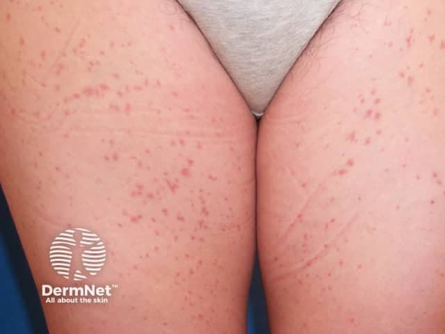 This dermatology clinical photograph demonstrates bilateral anterior thighs with a scattered eruption of small, non-blanching red-to-purple macules and papules consistent with cutaneous vasculitis. The lesions are primarily pinpoint to palm-sized clusters, with some faint purpuric coalescence along the inguinal folds. The appearance is compatible with palpable purpura from leukocytoclastic vasculitis (small-vessel vasculitis) affecting dermal capillaries. The distribution is symmetrical and non-exudative, without overt necrosis. No ulceration. The image is acquired as a close-up frontal view using digital photography in standard diagnostic lighting. There is a labeling watermark. The clinical significance: cutaneous vasculitis may be primary or secondary (infection, medications, autoimmune disease). Diagnostic significance: must correlate with symptoms, complete history, and laboratory tests; confirm by skin biopsy with immunofluorescence showing leukocytoclastic vasculitis and possibly IgA deposition in IgA vasculitis. Differential diagnoses include Henoch-Schonlein purpura (IgA vasculitis), drug-induced leukocytoclastic vasculitis, cryoglobulinemic vasculitis, essential thrombocytopenia-associated purpura, pityriasis lichenoides et varioliformis acuta. Potential clinical use cases: dermatology teaching, triage in suspected systemic vasculitis, biopsy planning, case series documentation, AI-enabled image retrieval for vasculitis phenotypes. Limitations of a single-view image include potential underestimation of lesion depth and evolution. For documentation, standardize lighting, include multiple angles, and capture high-resolution regional views. Serial photographs can help track progression and response to therapy and monitor systemic involvement.