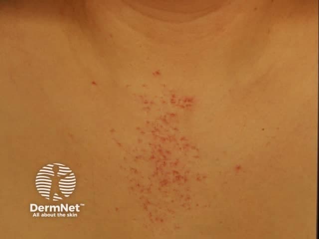 Imaging modality: Clinical photography of a skin lesion; technique: standard color image, non-dermoscopic, frontal close-up. Not applicable for staining, contrast, or advanced imaging. Anatomical context: anterior neck and upper chest skin, involving superficial dermal vasculature. Visual features: a small central red papule with radiating fine vessels forming a spider-like pattern; vessels blanch with pressure; margins are well defined; surrounding skin appears otherwise normal. Pathology: spider angiomata (spider naevi), telangiectatic capillaries within the dermis; central nidus with radiating telangiectases; typically benign and asymptomatic. Clinical significance: common benign vascular lesion; often associated with estrogen states, pregnancy, or hepatic dysfunction when multiple lesions are present; usually solitary in healthy individuals. Diagnostic considerations: differentiate from cherry angioma, rosacea-related facial telangiectasia, angiokeratoma, or less likely malignant vascular tumors; dermoscopy may aid in ambiguous cases but was not employed here. Clinical utility: useful for dermatology education, teledermatology triage, and documentation of cutaneous vascular lesions; can guide evaluation of liver function if lesions are widespread; monitoring for changes suggesting damage or bleeding risk. Potential applications: dermatology training, vascular lesion cataloging, AI-assisted recognition, and research on prevalence and associations. This image supports educational examples of benign vascular mimics and aids clinicians in patient counseling and lesion monitoring.