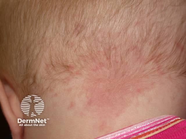 Imaging modality: Clinical photography of neonatal skin. The primary subject is a nevus simplex, commonly called a salmon patch, located on the posterior nape of the neck (occipital region). This flat, pink patch is blanchable with gentle pressure, well-demarcated, and non-palpable. The lesion lies within the dermis as a superficial capillary malformation with slow vascular filling, typical of nevus simplex. There is no surface atrophy, ulceration, or scaling. The surrounding skin shows normal neonatal hair distribution over the scalp. The appearance is a benign vascular lesion; in most infants it fades spontaneously within the first 1-2 years, though patches on the eyelids or glabella may persist longer. Clinically this lesion must be differentiated from more extensive capillary malformations such as port-wine stains, which tend to be darker, thicker, and persist or widen with time. The diagnostic significance is that this is a common, benign skin finding requiring no treatment. If the patch persists beyond early childhood, or is associated with other malformations (Sturge-Weber, etc.), further evaluation may be considered. This image is useful for dermatology education, newborn examination references, and image-based clinical decision support for capillary malformations. This supports standardized documentation and future comparative dermatologic research and training for clinicians.